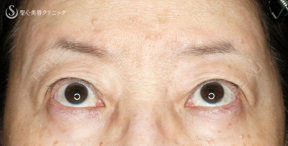【60代女性・ハードコンタクトによる眼瞼下垂】切らない眼瞼下垂+α法（術直後〜2年後） 730日後 メイン用