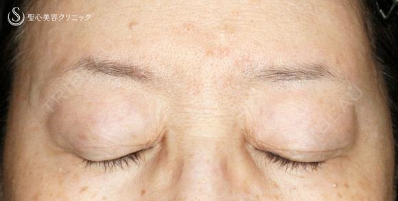 【60代女性・ハードコンタクトによる眼瞼下垂】切らない眼瞼下垂+α法（術直後〜2年後） 730日後 メイン用