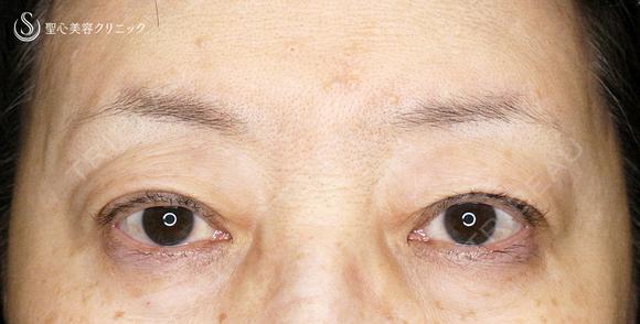 【60代女性・ハードコンタクトによる眼瞼下垂】切らない眼瞼下垂+α法（術直後〜2年後） 150日後 メイン用