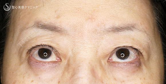 【60代女性・ハードコンタクトによる眼瞼下垂】切らない眼瞼下垂+α法（術直後〜2年後） 150日後 メイン用
