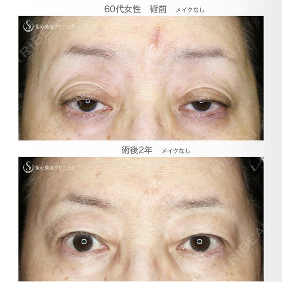 【60代女性・ハードコンタクトによる眼瞼下垂】切らない眼瞼下垂+α法（術直後〜2年後） 730日後 メイン用