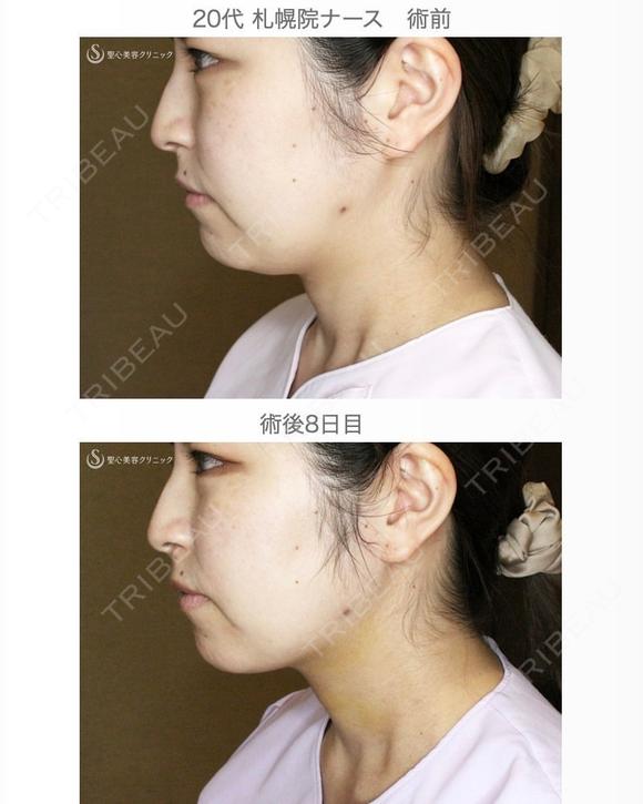 【20代女性・札幌院ナース】脂肪吸引注射「あご下」（直後〜8日目） before画像 メイン用