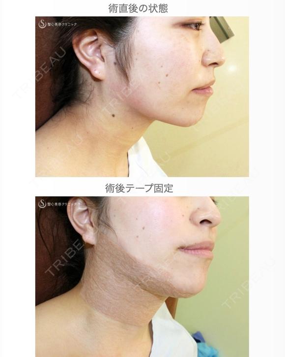 【20代女性・札幌院ナース】脂肪吸引注射「あご下」（直後〜8日目） after画像 メイン用