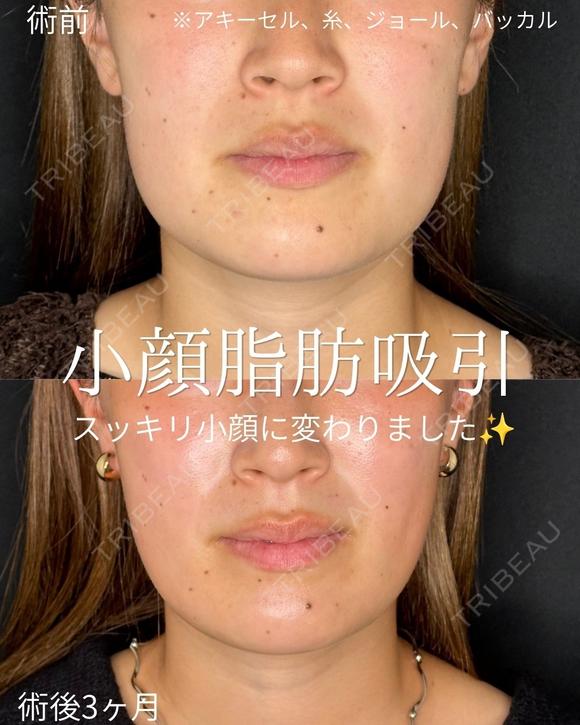 小顔脂肪吸引・糸・ジョール・バッカル除去※アキーセル使用 before画像 メイン用