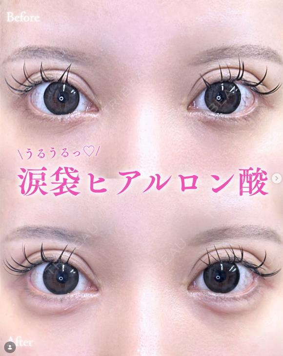 涙袋ヒアルロン酸 1日後 メイン用