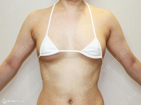【25歳女性・繊維質の脂肪で吸引に苦労したケース】プレミアムセリューション豊胸術（3ヶ月後） 90日後 メイン用