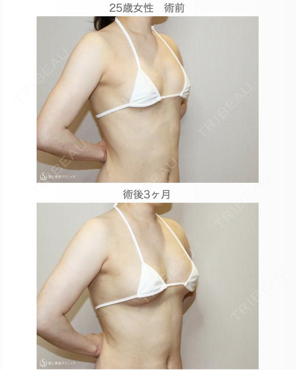 【25歳女性・繊維質の脂肪で吸引に苦労したケース】プレミアムセリューション豊胸術（3ヶ月後） after画像 メイン用