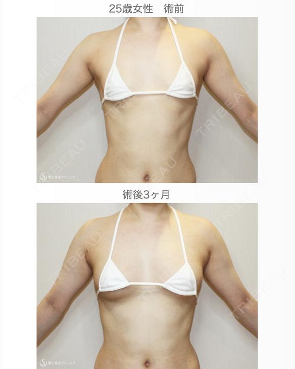 【25歳女性・繊維質の脂肪で吸引に苦労したケース】プレミアムセリューション豊胸術（3ヶ月後） after画像 メイン用