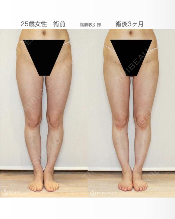 【25歳女性・繊維質の脂肪で吸引に苦労したケース】プレミアムセリューション豊胸術（3ヶ月後） after画像 メイン用