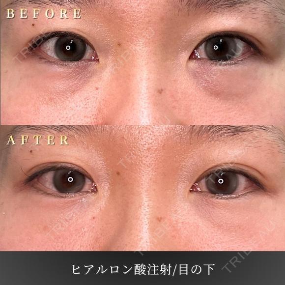 ヒアルロン酸注入術/目の下 after画像 メイン用