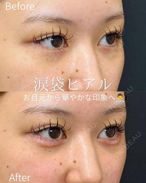 涙袋ヒアルロン酸 before画像 メイン用