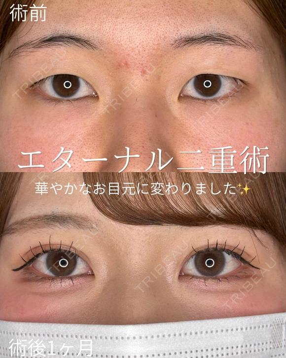 エターナル二重術 before画像 メイン用