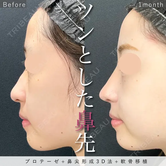 ツンとした美鼻に♡プロテーゼ+鼻尖形成3D法+軟骨移植 before画像 メイン用