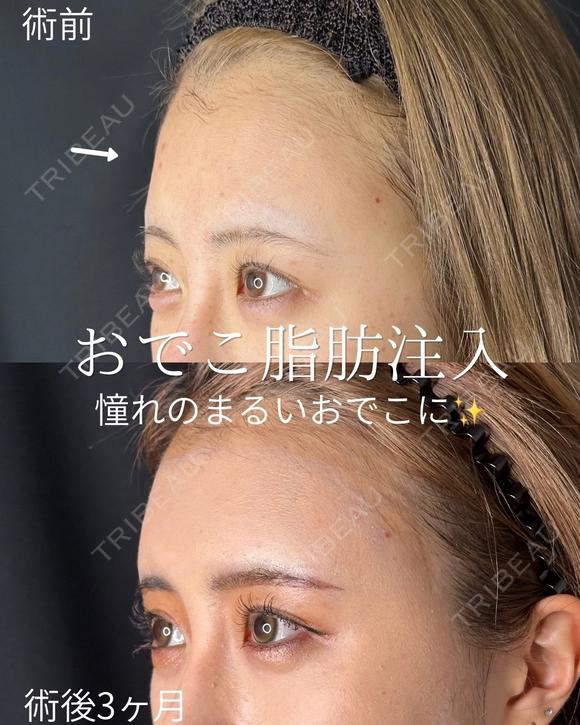 おでこ脂肪注入 before画像 メイン用