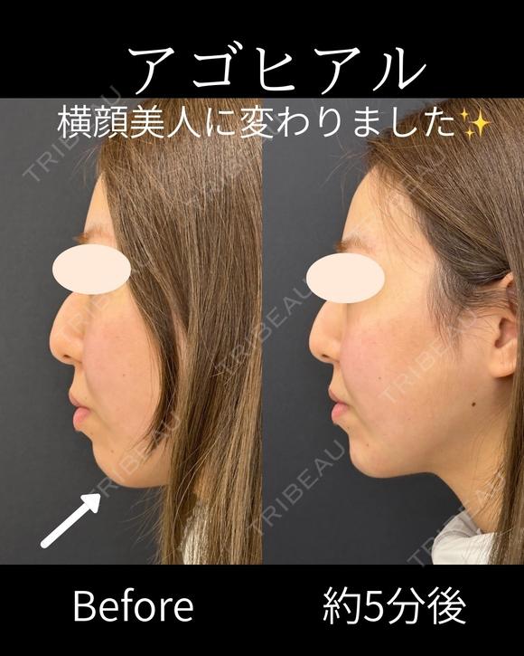 アゴヒアルロン酸 before画像 メイン用