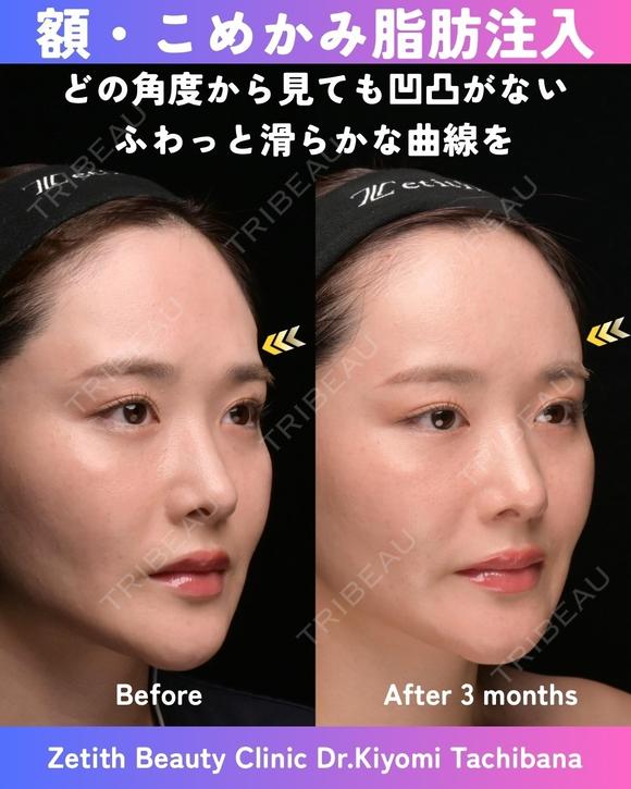 額・こめかみ脂肪注入 90日後 メイン用