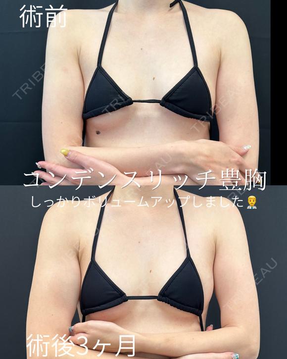 コンデンスリッチ豊胸 before画像 メイン用