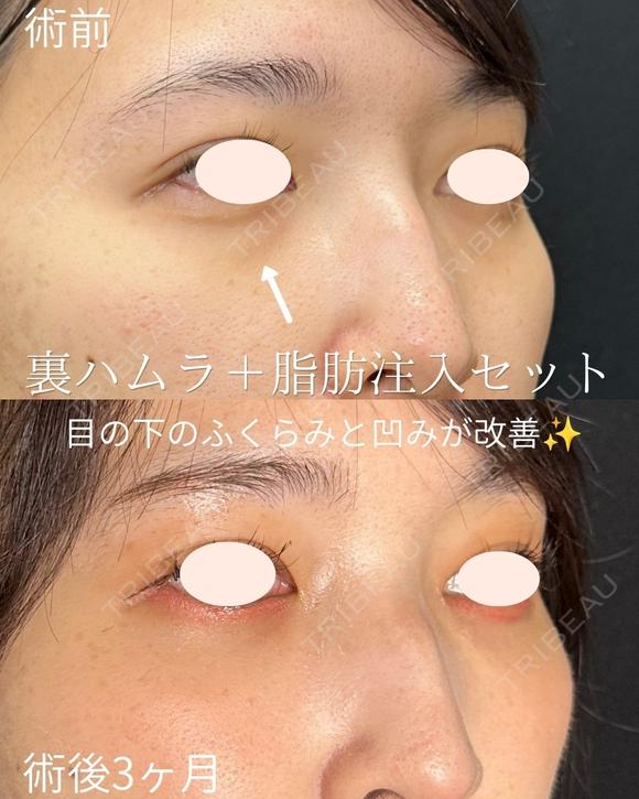 裏ハムラ+脂肪注入 before画像 メイン用