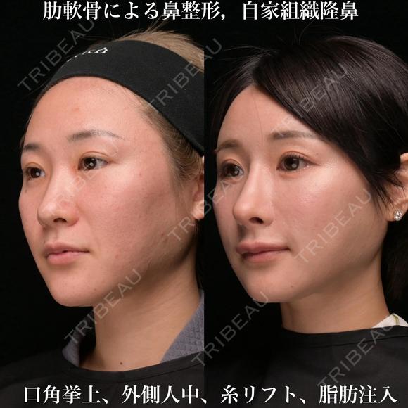 肋軟骨による鼻整形 180日後 メイン用
