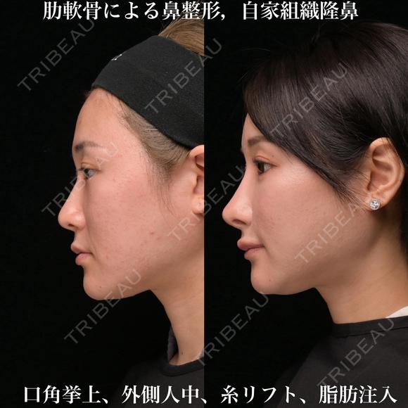 肋軟骨による鼻整形 180日後 メイン用