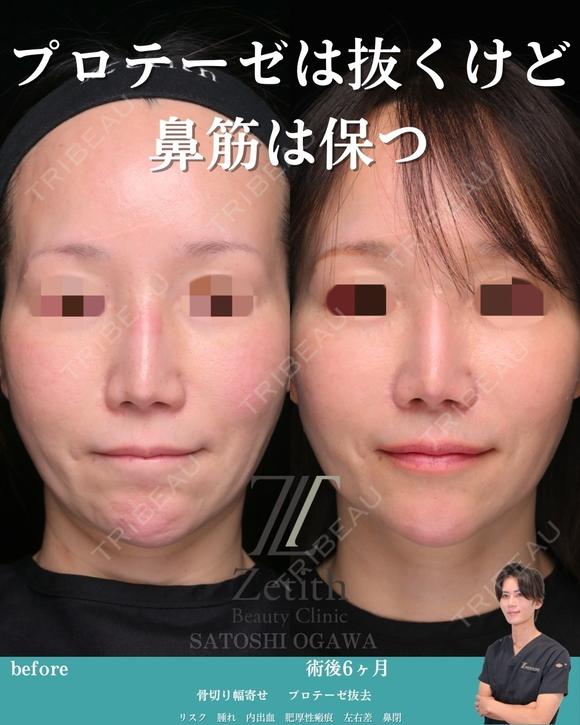 プロテーゼは抜くけど鼻筋は保つ 180日後 メイン用