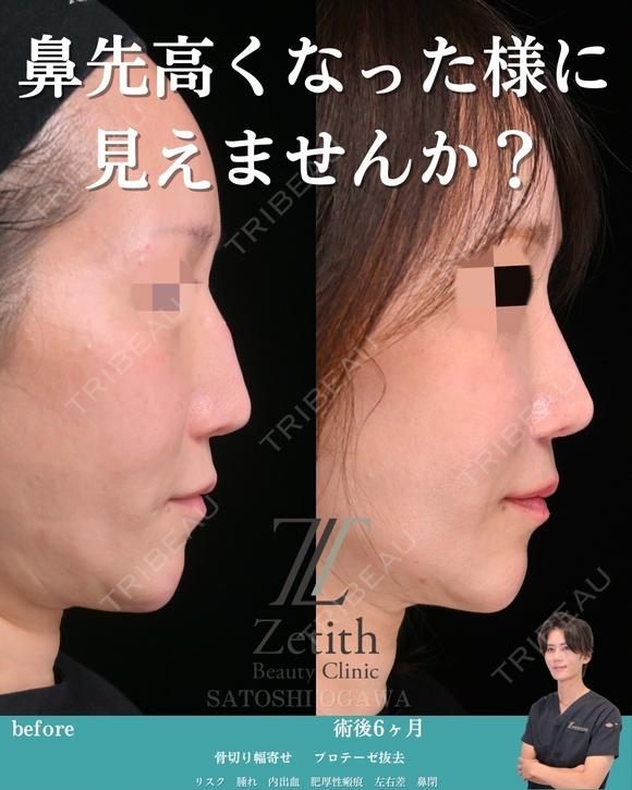 プロテーゼは抜くけど鼻筋は保つ 180日後 メイン用