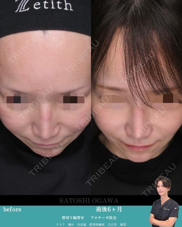 プロテーゼは抜くけど鼻筋は保つ 180日後 メイン用