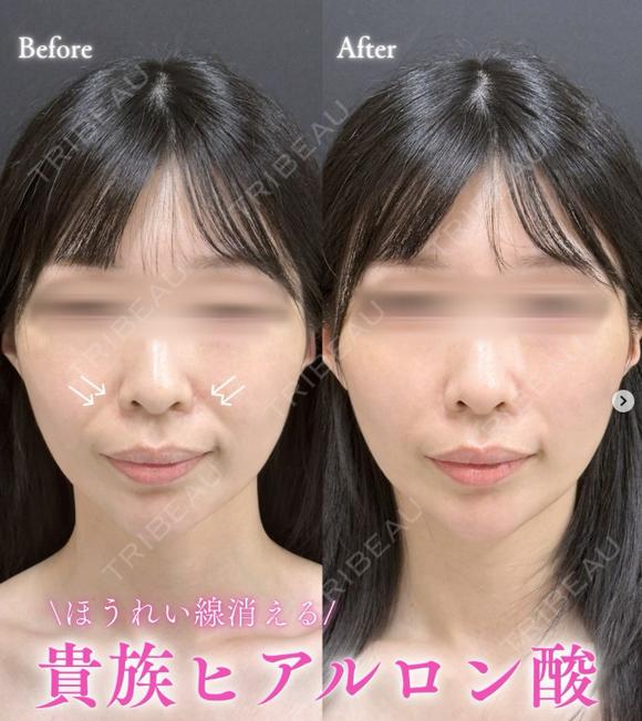 貴族ヒアルロン酸 1日後 メイン用