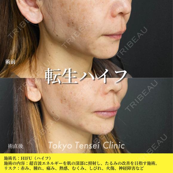 転生ハイフ before画像 メイン用