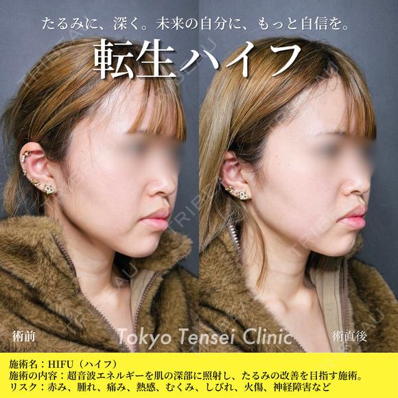 転生ハイフ before画像 メイン用