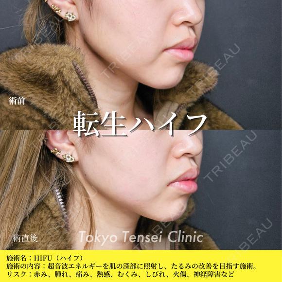 転生ハイフ after画像 メイン用