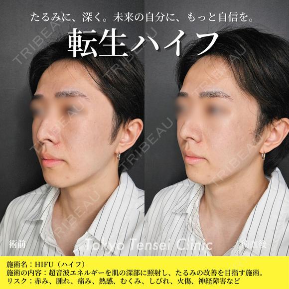 転生ハイフ before画像 メイン用