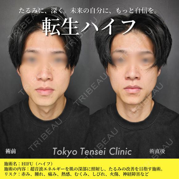 転生ハイフ before画像 メイン用