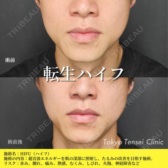 転生ハイフ after画像 メイン用