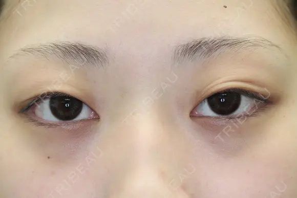 フォーエバーブリリアント埋没法 before画像 メイン用