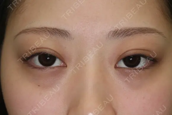 フォーエバーブリリアント埋没法 after画像 メイン用