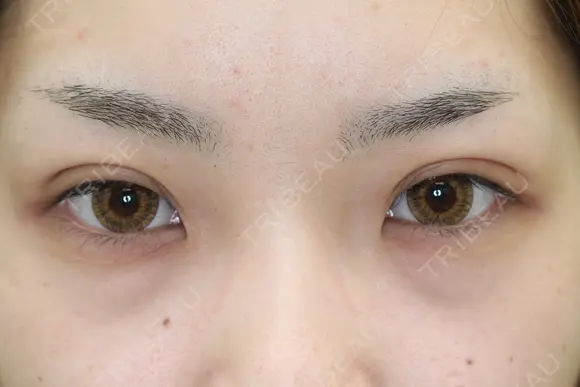 フォーエバーブリリアント埋没法 after画像 メイン用