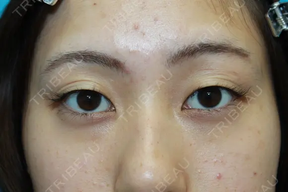 フォーエバーブリリアント埋没法 before画像 メイン用