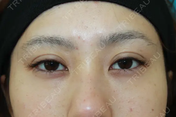 フォーエバーブリリアント埋没法 after画像 メイン用