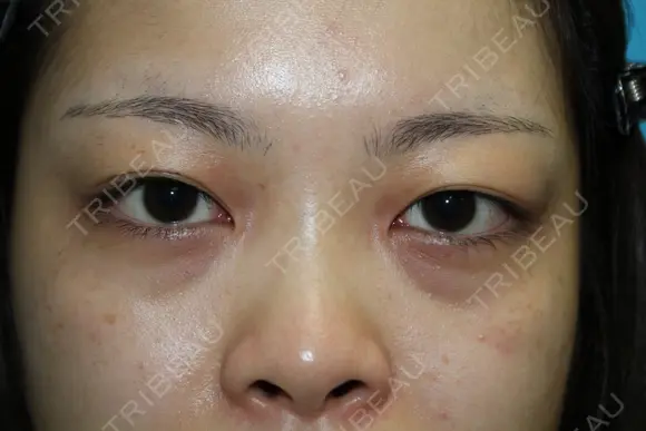 フォーエバーブリリアント埋没法 before画像 メイン用