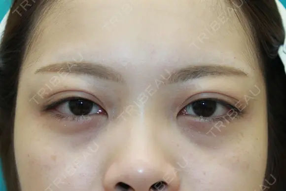 フォーエバーブリリアント埋没法 after画像 メイン用