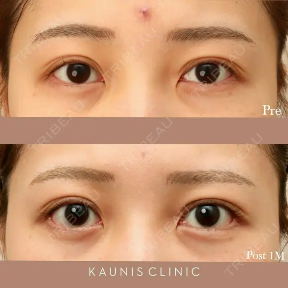 下眼瞼拡大（グラマラスライン）、目尻切開 before画像 メイン用