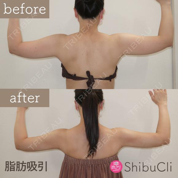 脂肪吸引 after画像 メイン用