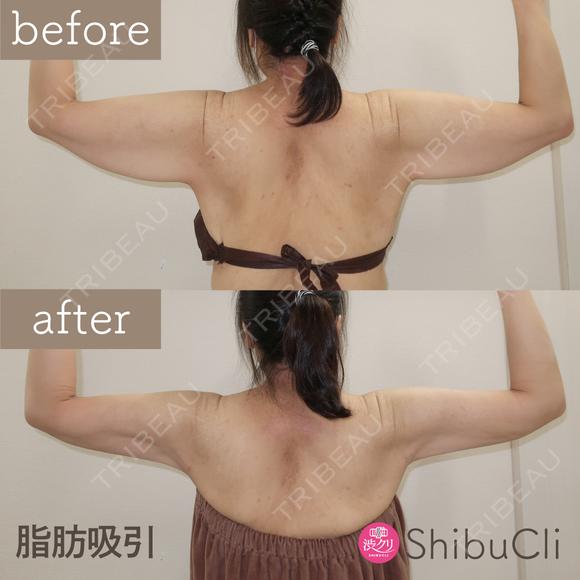 脂肪吸引 before画像 メイン用
