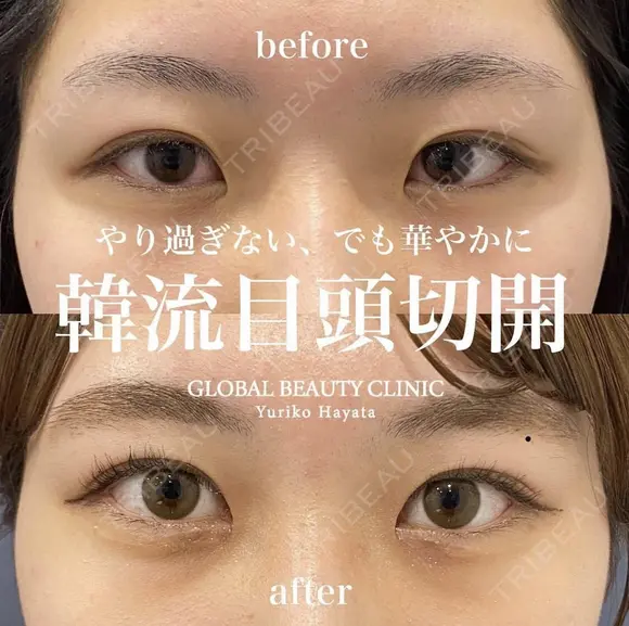 韓流目頭切開法 before画像 メイン用