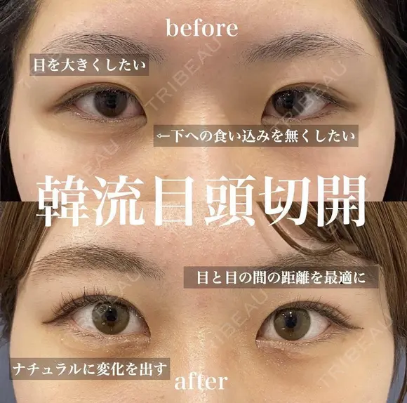 韓流目頭切開法 after画像 メイン用