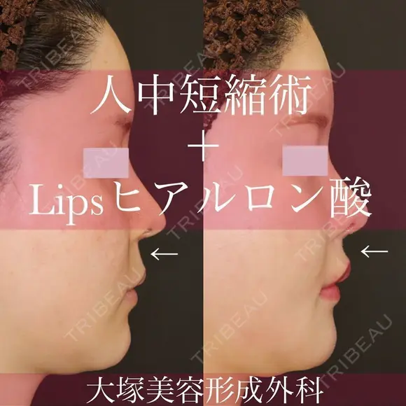美ライン💋人中短縮術(リップリフト)＋Lipsヒアルロン酸注入 before画像 メイン用
