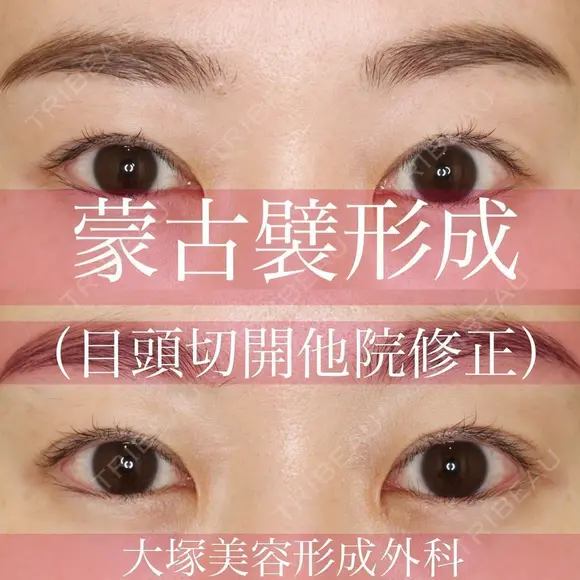 ナチュラルなデカ目💗蒙古襞形成(目頭切開他院修正) before画像 メイン用