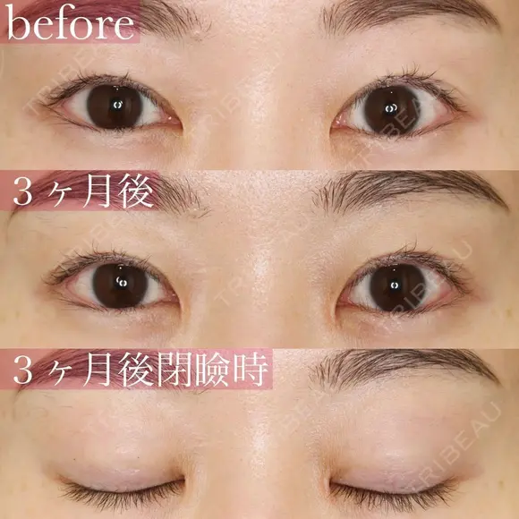 ナチュラルなデカ目💗蒙古襞形成(目頭切開他院修正) 90日後 メイン用