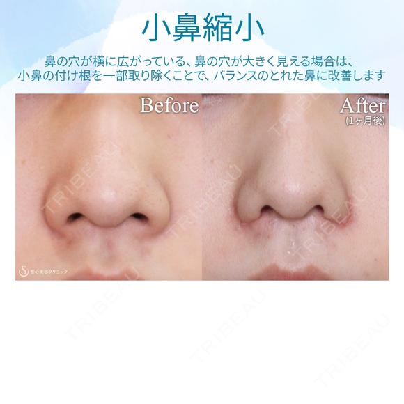 【10代女性・小鼻を小さく】小鼻縮小術 before画像 メイン用